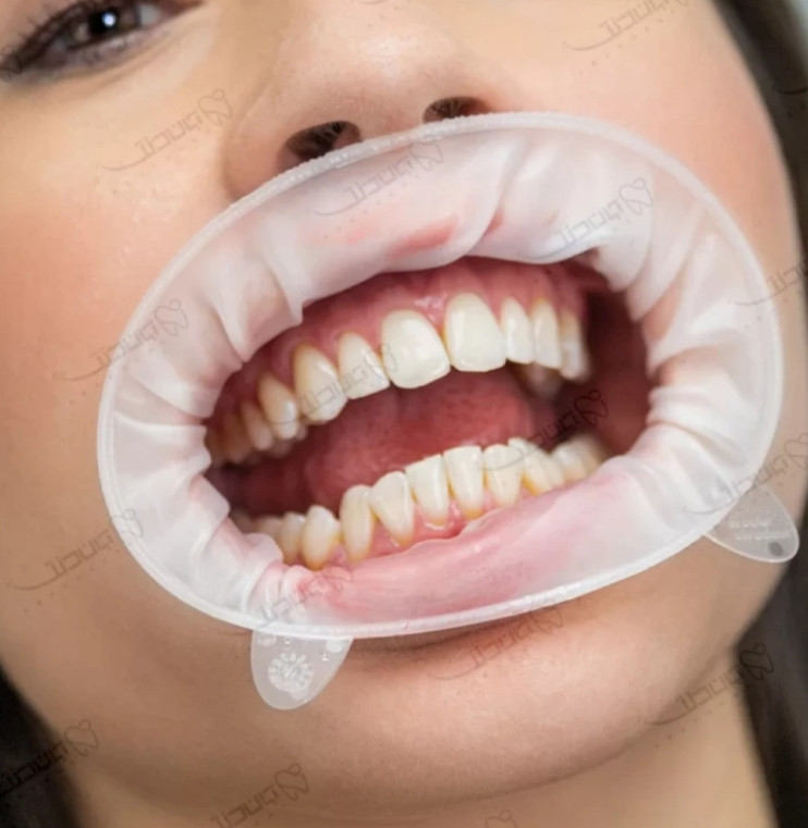 دهان بازکن اپترا گیت Ivoclar Vivadent optragate